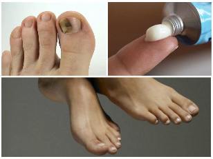 the nail fungus in the foot ointment
