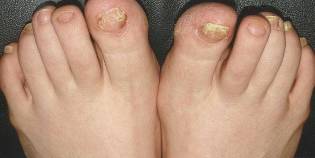 what is nail fungus