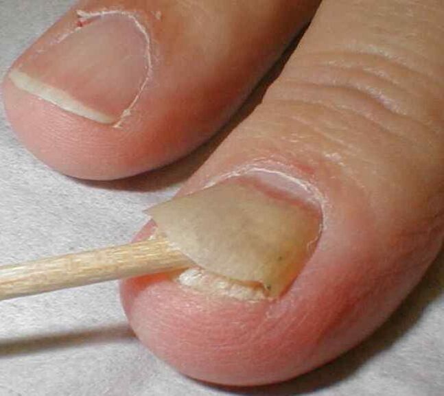 Peeling nails with toenail fungus