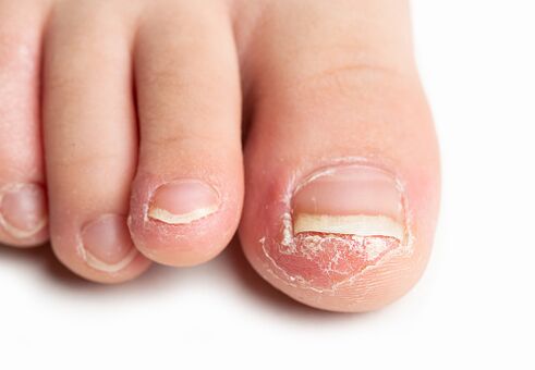 What does toenail fungus look like