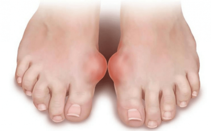 Deformities of the feet are the cause of fungus appearing on the legs