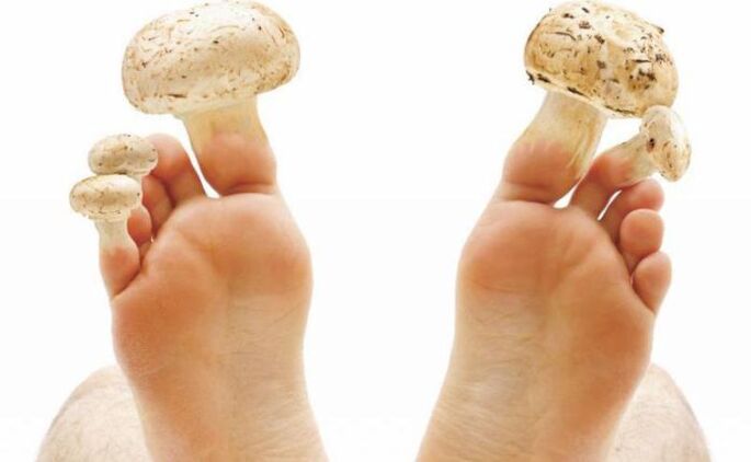 Etiology, symptoms and treatment of foot fungus