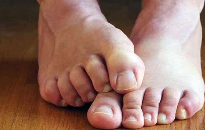 Symptoms of foot squamous fungus
