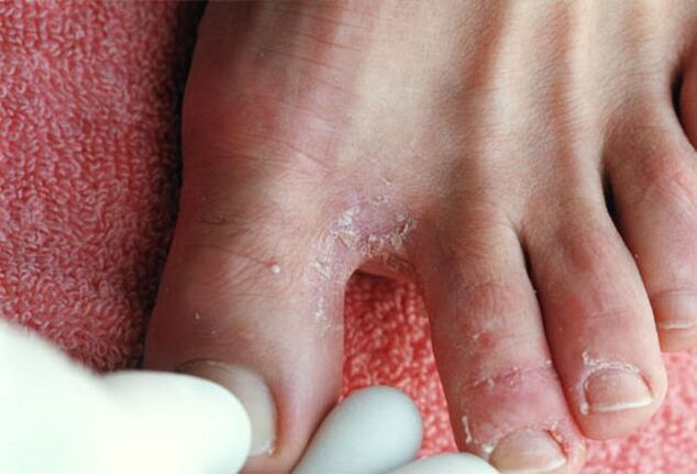 Fungal symptoms between the toes