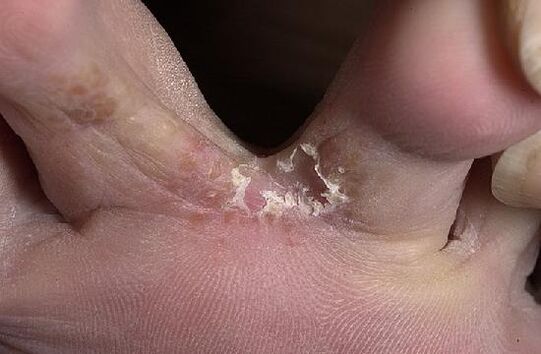 Toes affected by fungus