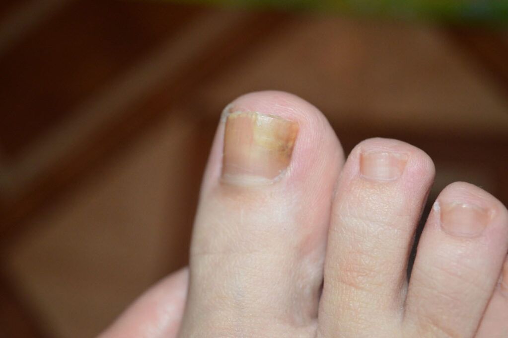 Early toenail fungus