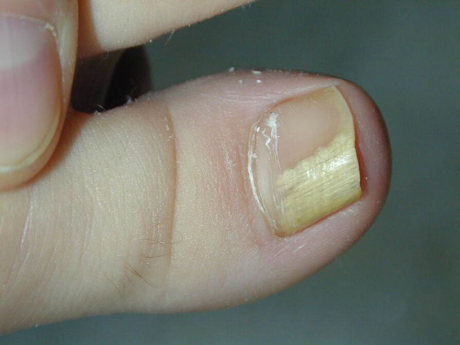 Fungal symptoms-discoloration of nails
