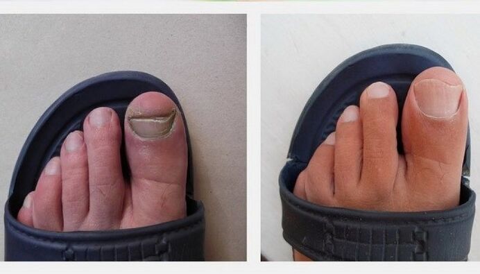 Toenails before and after treating fungus with apple cider vinegar