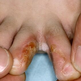 signs of fungus between toes