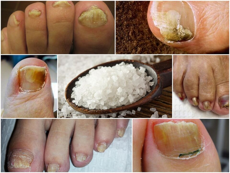 The struggle with fungi