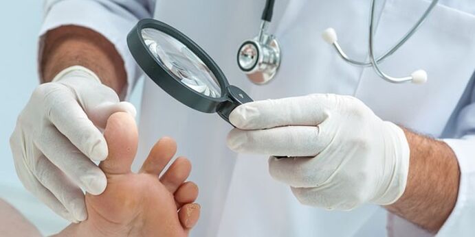 Doctor examines foot infected with fungi