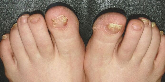 Nail spinal disease on the legs
