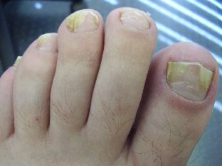 the fungus in the foot