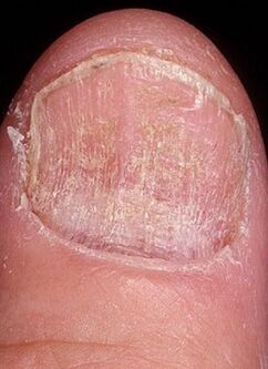 Mold diseases of nails