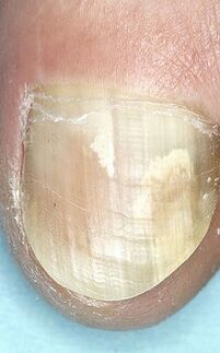 Nail fungus
