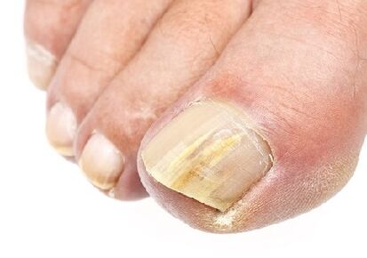 What is nail fungus like