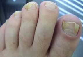 Effects of fungal infections in nails