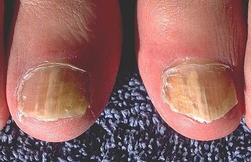 Nails affected by skin plants