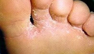 How to identify fungi on your fingers