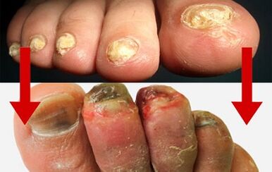 The manifestation of fungi on the fingers