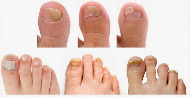 The first symptoms of onychomycosis