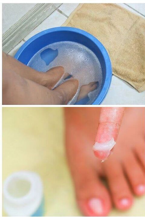 Using natural oils to treat toenail fungus