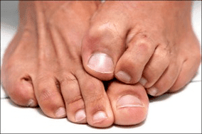 Itchy skin on feet due to fungal nail infection