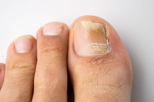Onychomycosis