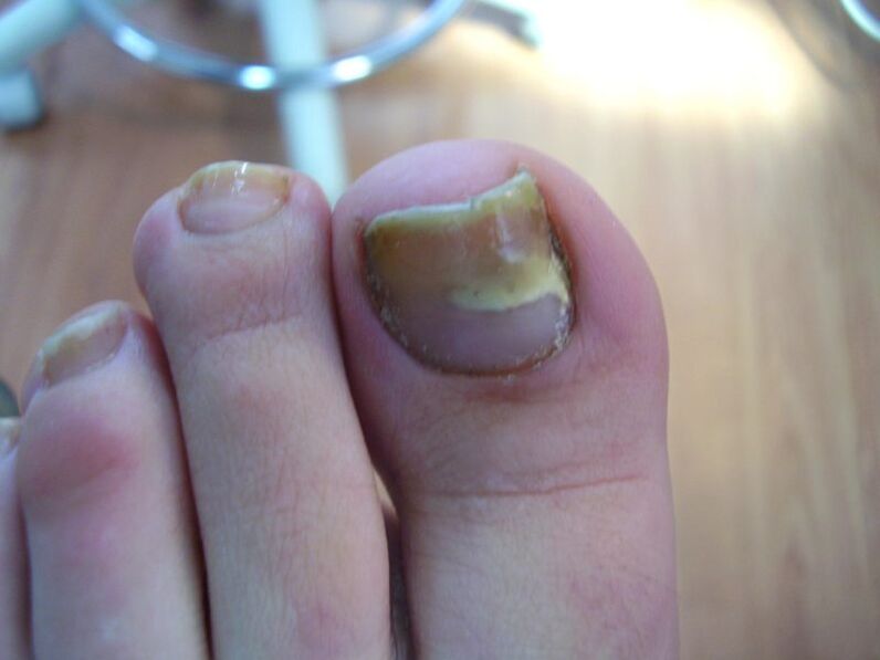 How to Treat Yellow Nails Caused by Fungus with Drops