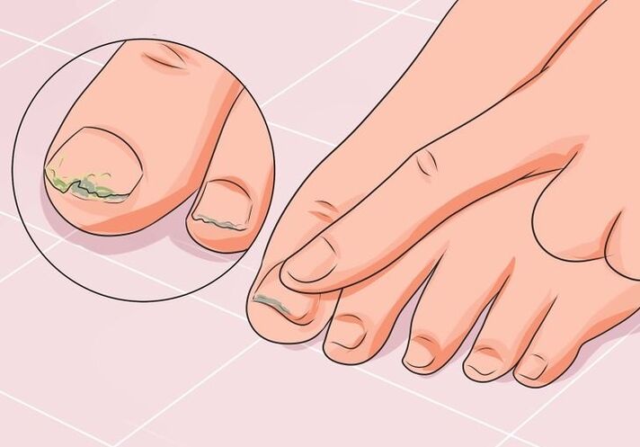 How to treat onychomycosis with drops