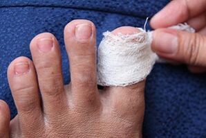 Compress onychomycosis
