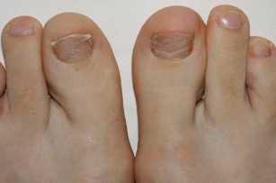 Symptoms appearance of fungi on the feet