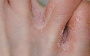 skin fungus on legs