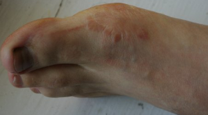 the fungus in the foot, the initial phase